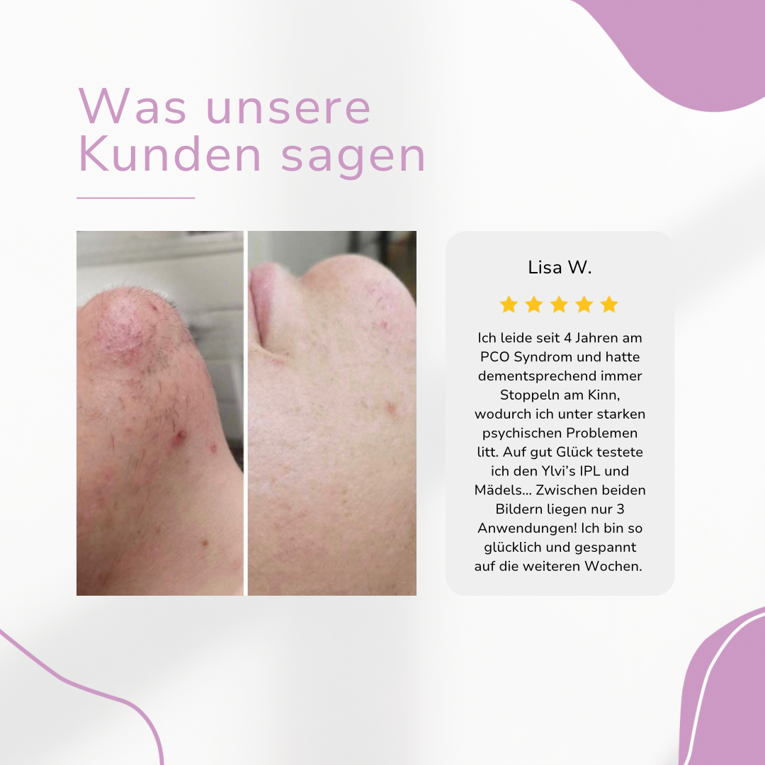 HaarMony IPL Hair Remover I Die führende Laser-Haar-Entfernung für Zuhause