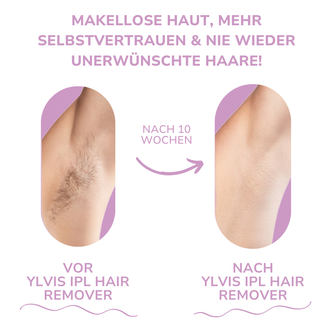 HaarMony IPL Hair Remover I Die führende Laser-Haar-Entfernung für Zuhause