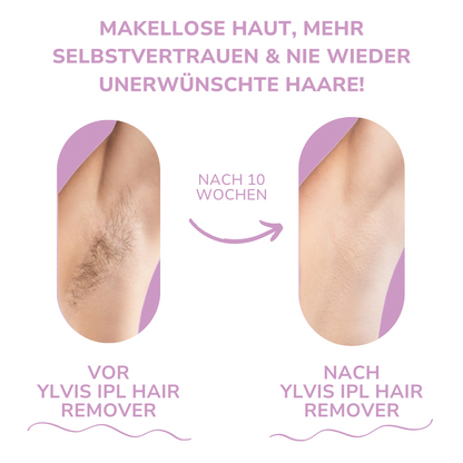 HaarMony IPL Hair Remover I Die führende Laser-Haar-Entfernung für Zuhause